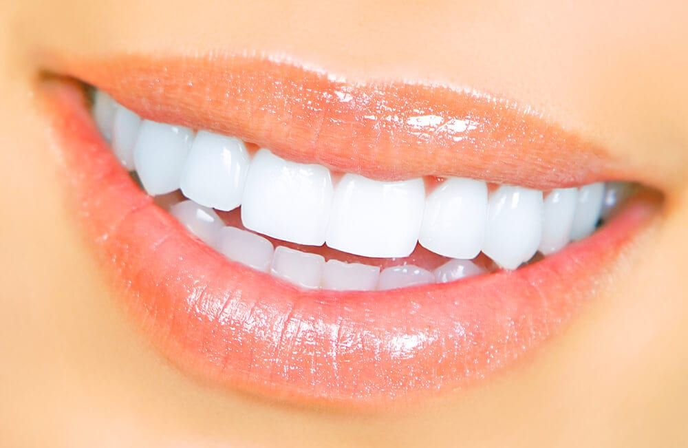 beautiful teeth after teeth whitening treatment