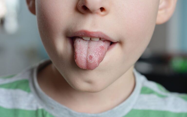 Child experiencing salivary gland problems