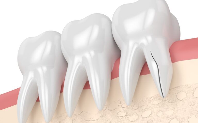 3D Vendor of Teeth With Vertical Root Fractures